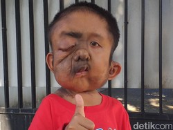 Kasihan, Bocah Yatim Piatu Ini Idap Empat Jenis Kanker dan Tumor