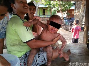 Kelainan Genetik, Sekujur Tubuh Bocah NTB Ini Tampak Melepuh dan Bersisik