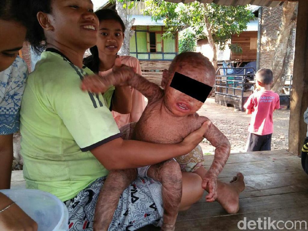 Kelainan Genetik, Sekujur Tubuh Bocah NTB Ini Tampak Melepuh dan Bersisik Kelainan Genetik, Sekujur Tubuh Bocah NTB Ini Tampak Melepuh dan Bersisik