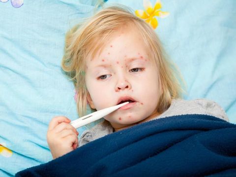 Cacar Air pada Anak, Kenali Gejala dan Cara Penanganannya