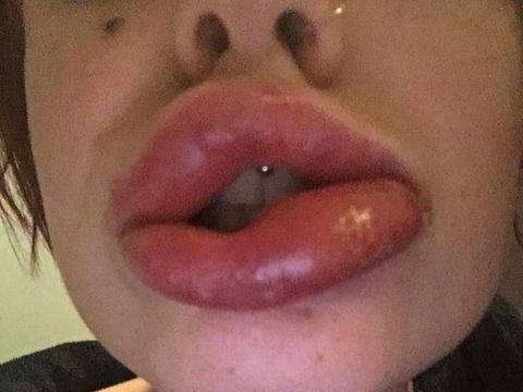 Gara-gara Filler, Bibir Perempuan Ini Membusuk & Bengkak Seperti Sosis