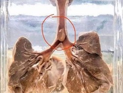 Viral Foto Kacang Nyangkut di Saluran Pernapasan Gara-gara Tersedak