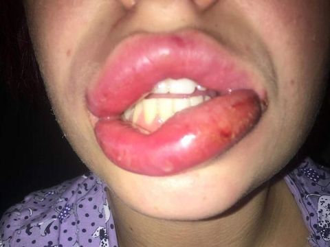 Gara-gara Filler, Bibir Perempuan Ini Membusuk & Bengkak Seperti Sosis