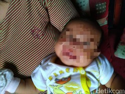 Ditinggal Ibu ke Toilet, Wajah Bayi di Bogor Terluka Digigit Tikus Besar