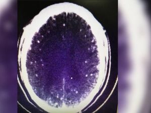 Otak Pria Ini Terinfeksi Cacing, Gara-gara Makan Daging Setengah Matang