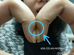 Viral Tes Dempetkan Dua Kuku Bisa Ungkap Risiko Kanker Paru, Percaya?