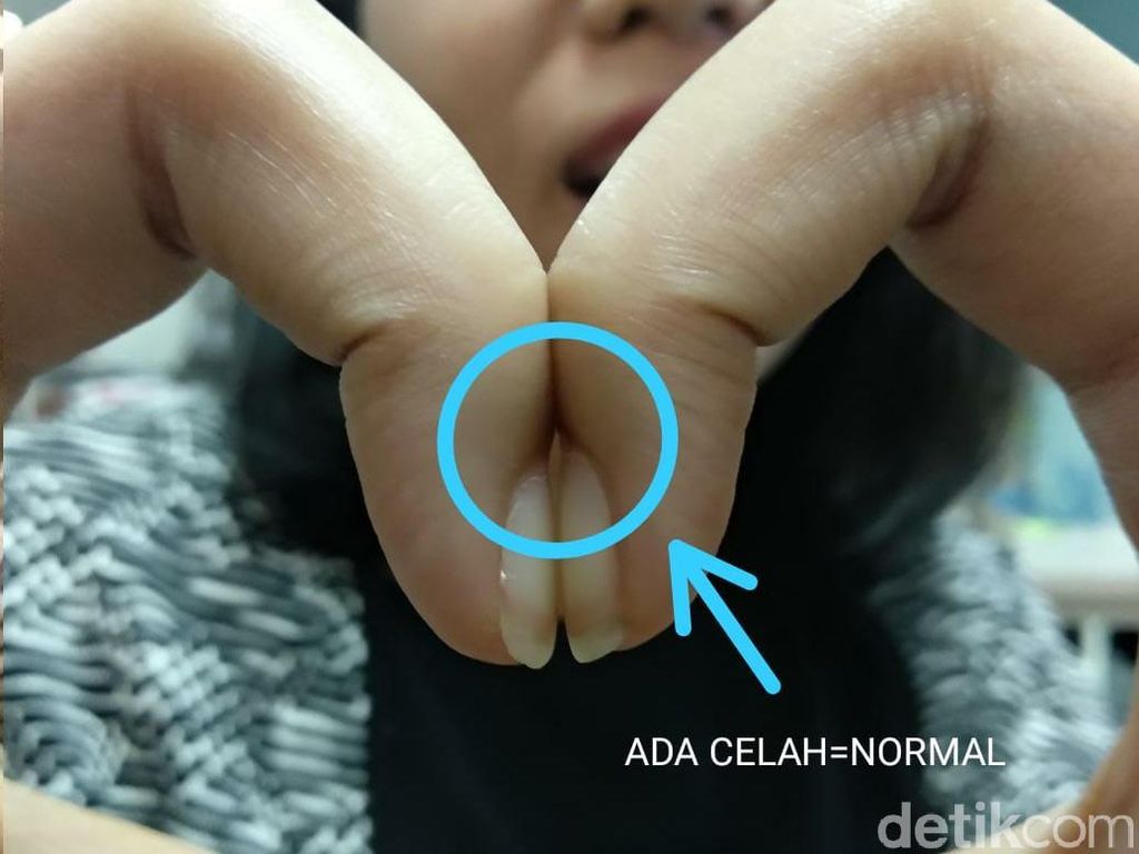 Tanggapan Dokter Soal Viral Tes Dempetkan Kuku Ungkap Risiko Kanker Paru Tanggapan Dokter Soal Viral Tes Dempetkan Kuku Ungkap Risiko Kanker Paru