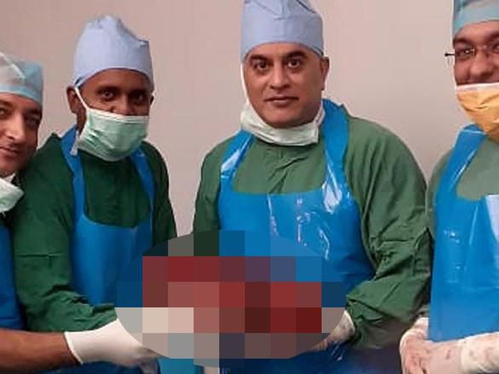 Punya Kondisi Langka, Ginjal Raksasa 7,4 Kg Diangkat dari Tubuh Pria Ini Punya Kondisi Langka, Ginjal Raksasa 7,4 Kg Diangkat dari Tubuh Pria Ini