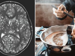 Hii! 5 Kisah Mengerikan Cacing Bersarang di Tubuh karena Makan Daging Babi Hii! 5 Kisah Mengerikan Cacing Bersarang di Tubuh karena Makan Daging Babi