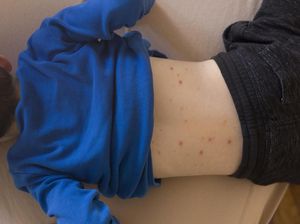 Video Menkes Budi Soroti Wabah Campak di AS, Sebut Sebagai Dampak Antivax Video Menkes Budi Soroti Wabah Campak di AS, Sebut Sebagai Dampak Antivax