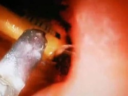 Iseng Saat Mabuk Telan Korek Api, Perut Pria Ini Hampir Meledak