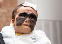 Takjub! Operasi Tanda Lahir 'Batman' di Wajah Bayi Ini Tanpa Bekas Luka