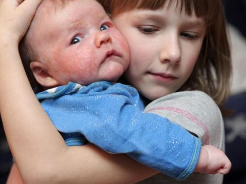 The girl embraces her sick brother with eczema