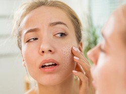 10 Cara Mengatasi Kulit Wajah Kering yang Ganggu Penampilan