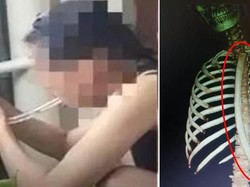 Ngebet Kurus, Wanita Ini Tertelan Tabung Panjang Saat Paksa Muntahkan Makanan