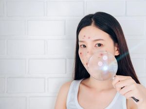Ada Jerawat Membandel, Dibiarkan Saja atau Dipencet? Ada Jerawat Membandel, Dibiarkan Saja atau Dipencet?