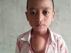 Pemkot Makassar Tanggung Biaya RS Bocah Suman yang Punya Benjolan di Dada