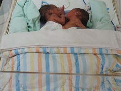 Lengket Perut dan Dada, Bayi Kembar Siam di Medan Dalam Keadaan Sehat
