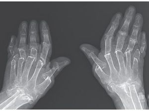 Idap Radang Otot, Jemari Tangan Nenek Ini Menekuk ke Samping