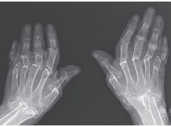 Idap Radang Otot, Jemari Tangan Nenek Ini Menekuk ke Samping