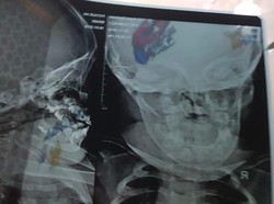 Viral Bayi 15 Bulan Nyaris Lumpuh Gara-gara Dicium Paksa