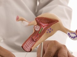 Penyebab dan Prosedur Pengangkatan Rahim atau Histerektomi