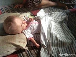 Kendala Biaya Transportasi, Ortu Balita Hydrocephalus Tak Mampu Rujuk Anaknya Kendala Biaya Transportasi, Ortu Balita Hydrocephalus Tak Mampu Rujuk Anaknya