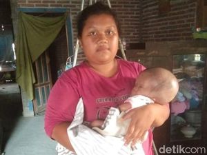Kisah Balita Zahra, Penderita Hydrocephalus Sejak Lahir di Blitar Kisah Balita Zahra, Penderita Hydrocephalus Sejak Lahir di Blitar