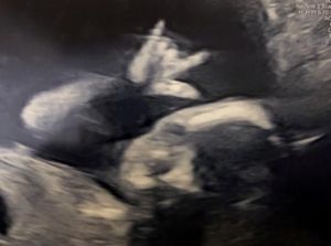 Langka! Hasil USG Perlihatkan Bayi Ini Tunjukkan Jari Gaya Metal Langka! Hasil USG Perlihatkan Bayi Ini Tunjukkan Jari Gaya Metal