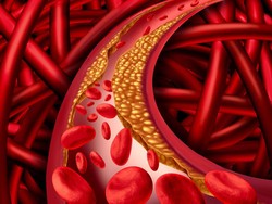 Ini Solusi Pangkas Lemak Darah yang Membumbung Tinggi