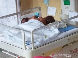 Ibu di Kalteng Lahirkan Bayi Kembar Siam Dempet Dada dan Perut