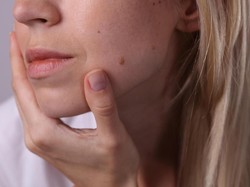 Ciri-ciri Tahi Lalat Menjelma Jadi Kanker Kulit Menurut Ahli