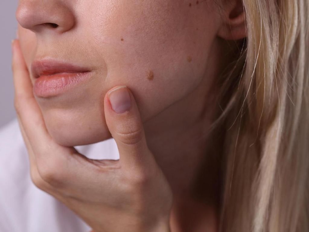 6 Penyebab Kanker Melanoma, Waspadai Tahi Lalat yang Tak Wajar! 6 Penyebab Kanker Melanoma, Waspadai Tahi Lalat yang Tak Wajar!