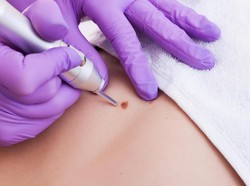 Kehamilan Picu Tahi Lalat di Pipi Wanita Ini Bengkak Jadi Kanker, Kok Bisa?