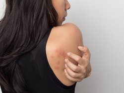 12 Obat Biduran Tradisional Ampuh, Pakai Bahan Alami