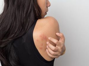Apa Itu Biduran? Yuk Kenali Penyebab dan Obat Gatal Biduran Apa Itu Biduran? Yuk Kenali Penyebab dan Obat Gatal Biduran