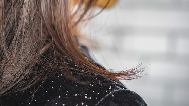 closeup woman hair with dandruff falling on shoulders