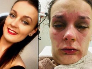 5 Bukti Kalau Kecelakaan Dapur Bisa Bahayakan Nyawa 5 Bukti Kalau Kecelakaan Dapur Bisa Bahayakan Nyawa