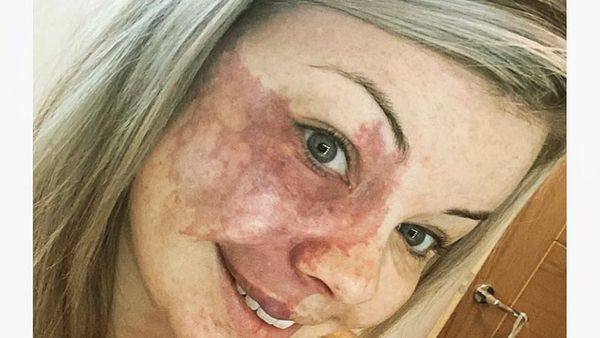 Potret Wanita dengan Tanda Lahir di Wajah, Kini PD Tampil Tanpa Makeup