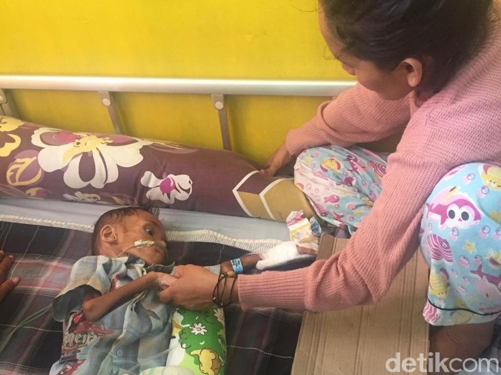 Bocah 3 Tahun Asal Buton Selatan Mengidap Gizi Buruk Bocah 3 Tahun Asal Buton Selatan Mengidap Gizi Buruk