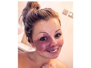 Kisah Wanita Punya Tanda Lahir Besar di Wajah, Berjuang untuk Percaya Diri