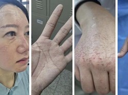 Terpopuler Sepekan: Tenaga Medis Rawat Pasien Virus Corona Sampai Luka