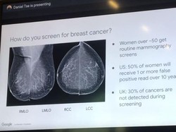 Teknologi AI Bantu Pemeriksaan Kanker Payudara