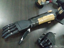 Sosok Bocah 5 Tahun Jadi Orang Termuda yang Pakai Tangan Bionik