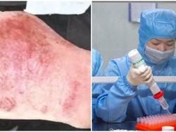 12 Jam Teliti Virus Corona, Tangan Dokter Ini Sampai Bengkak