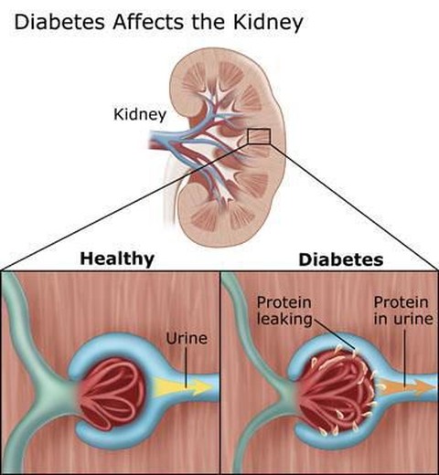 6 Efek Samping Tak Terduga dari Penyakit Diabetes