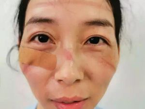 Kerja 24 Jam Tangani Virus Corona, Wajah Perawat di China Jadi Seperti Ini