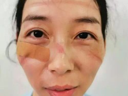 Kerja 24 Jam Tangani Virus Corona, Wajah Perawat di China Jadi Seperti Ini