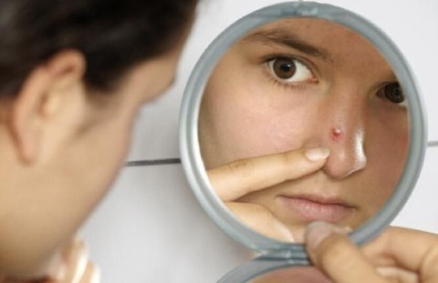 Mengulik Lebih Dalam Semua Tentang Serba Serbi Jerawat Di Hidung