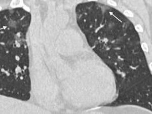 Beredar Penampakan Paru-paru yang Terinfeksi Virus Corona COVID-19 Beredar Penampakan Paru-paru yang Terinfeksi Virus Corona COVID-19